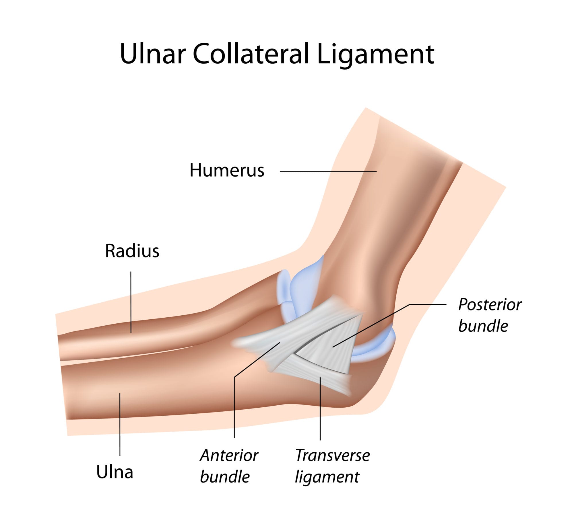 Ulnar collateral ligament tear